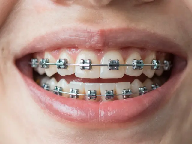 Proč se dělá mezera mezi zuby při léčbě fixními rovnátky?