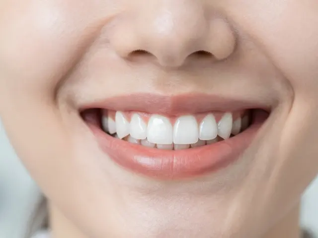 Fazety na křivé zuby: Jak získat rovný úsměv bez rovnatek