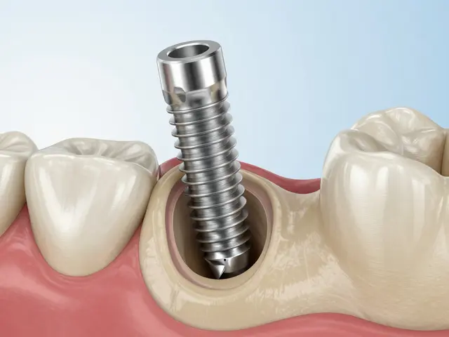 5 nejlepších výhod zubních implantátů: Proč jsou lepší než můstek nebo čelist