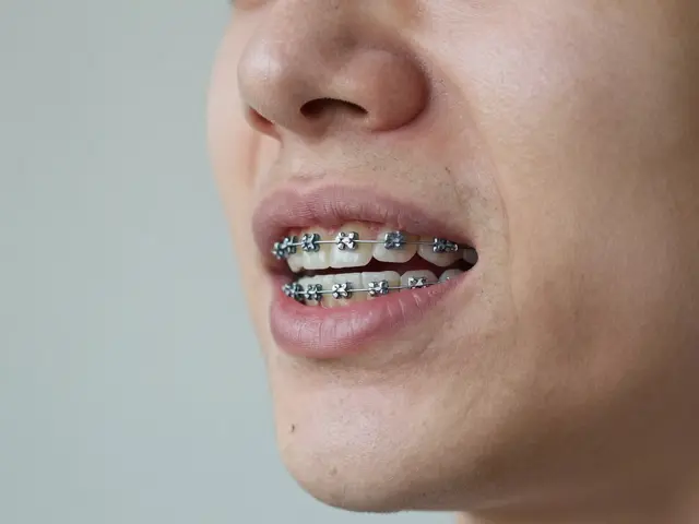 První týden s fixními rovnátky: 5 tipů pro hladký start bez bolesti